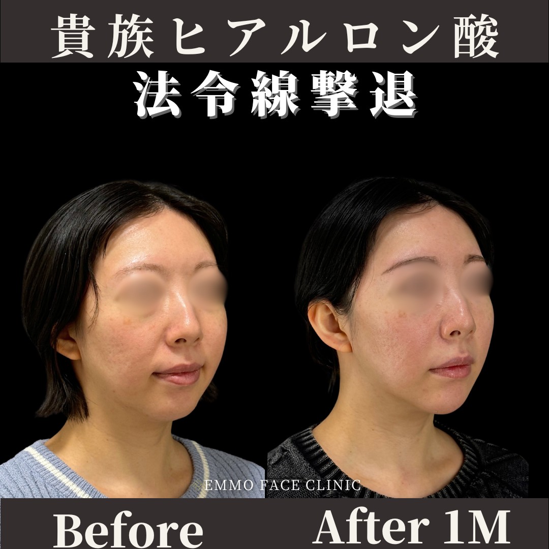 貴族ヒアルロン酸症例写真