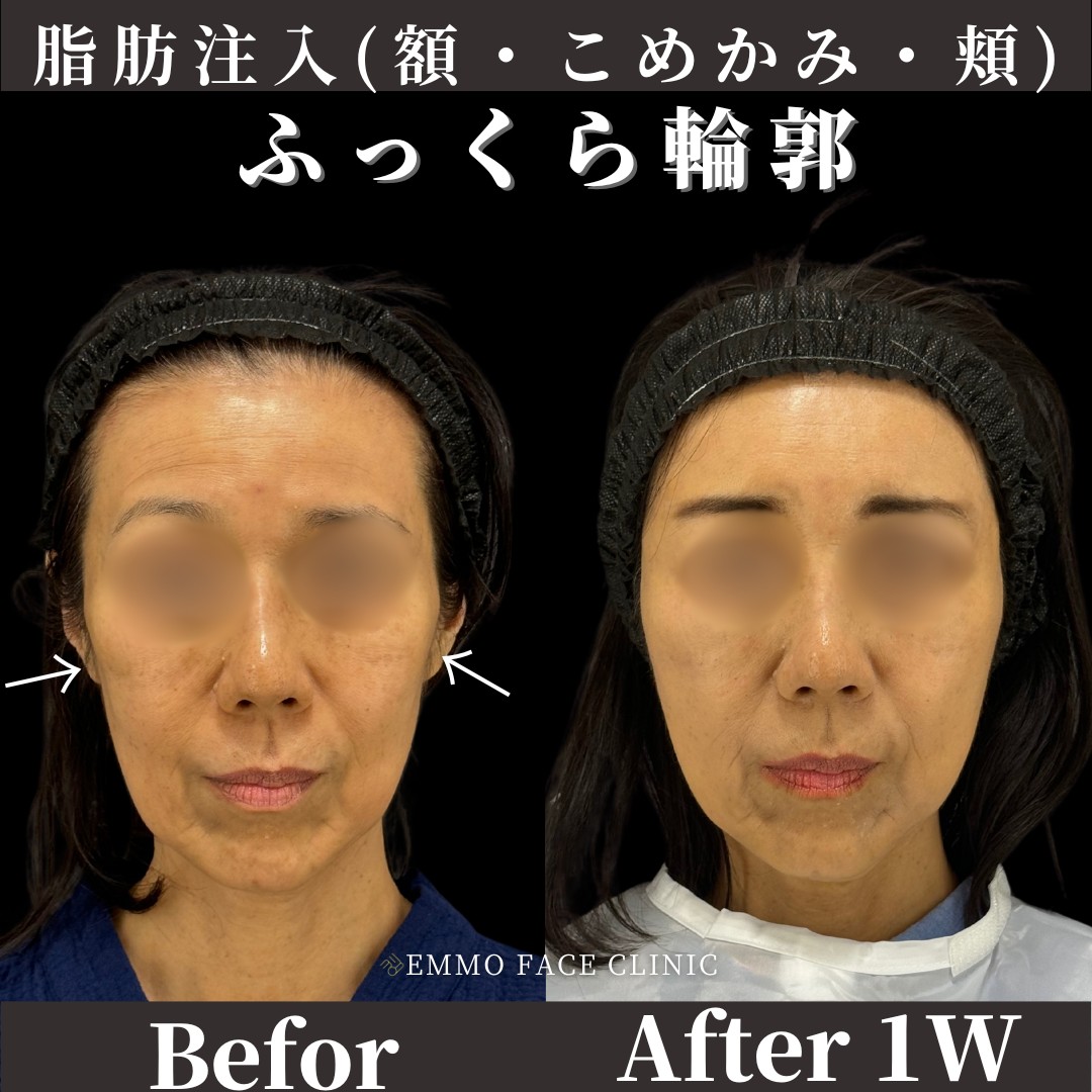 脂肪注入症例写真