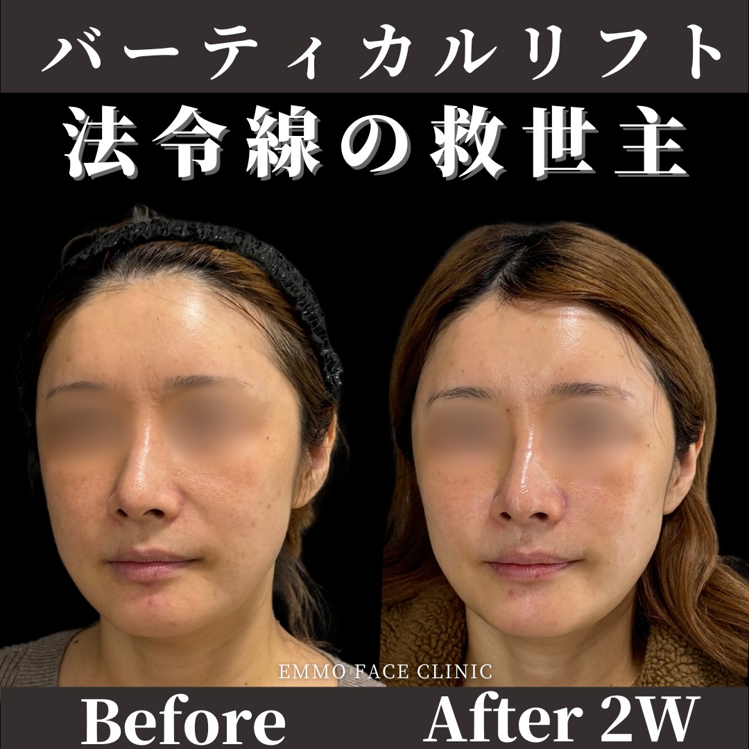 バーティカルリフト症例写真