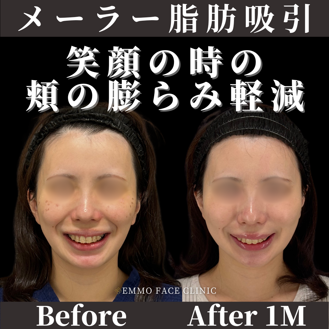 メーラーファット除去症例写真