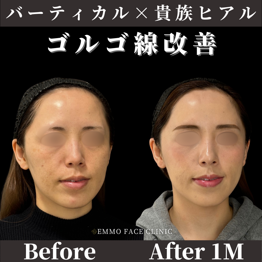 バーティカルリフト＋貴族ヒアルロン酸症例写真