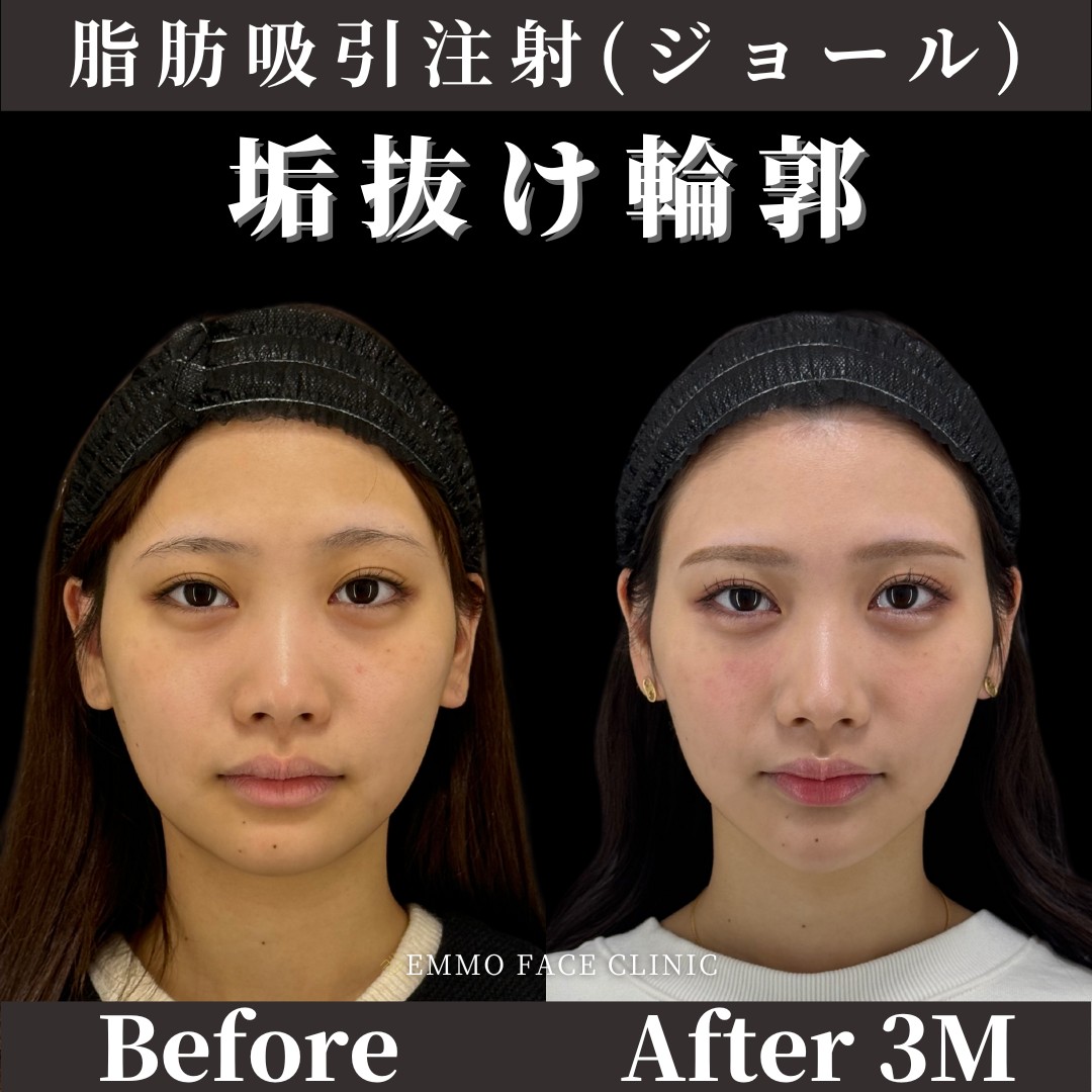 脂肪吸引注射＋バーティカルリフト症例写真