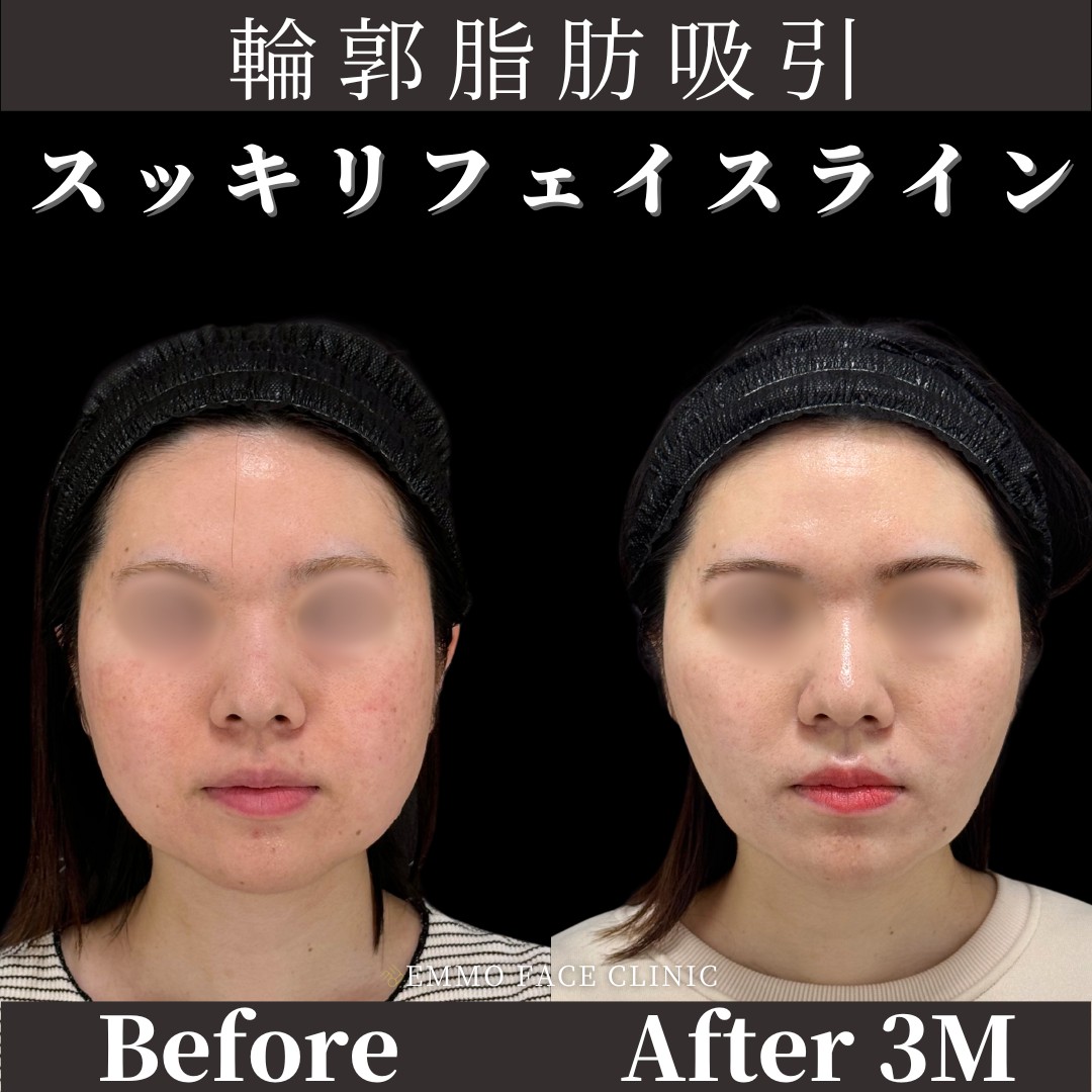 脂肪吸引＋バッカルファット除去症例写真