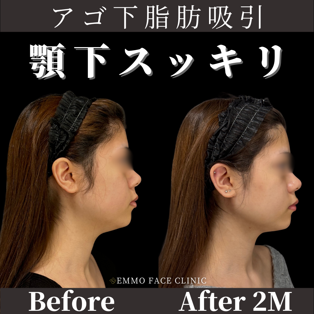 脂肪吸引症例写真