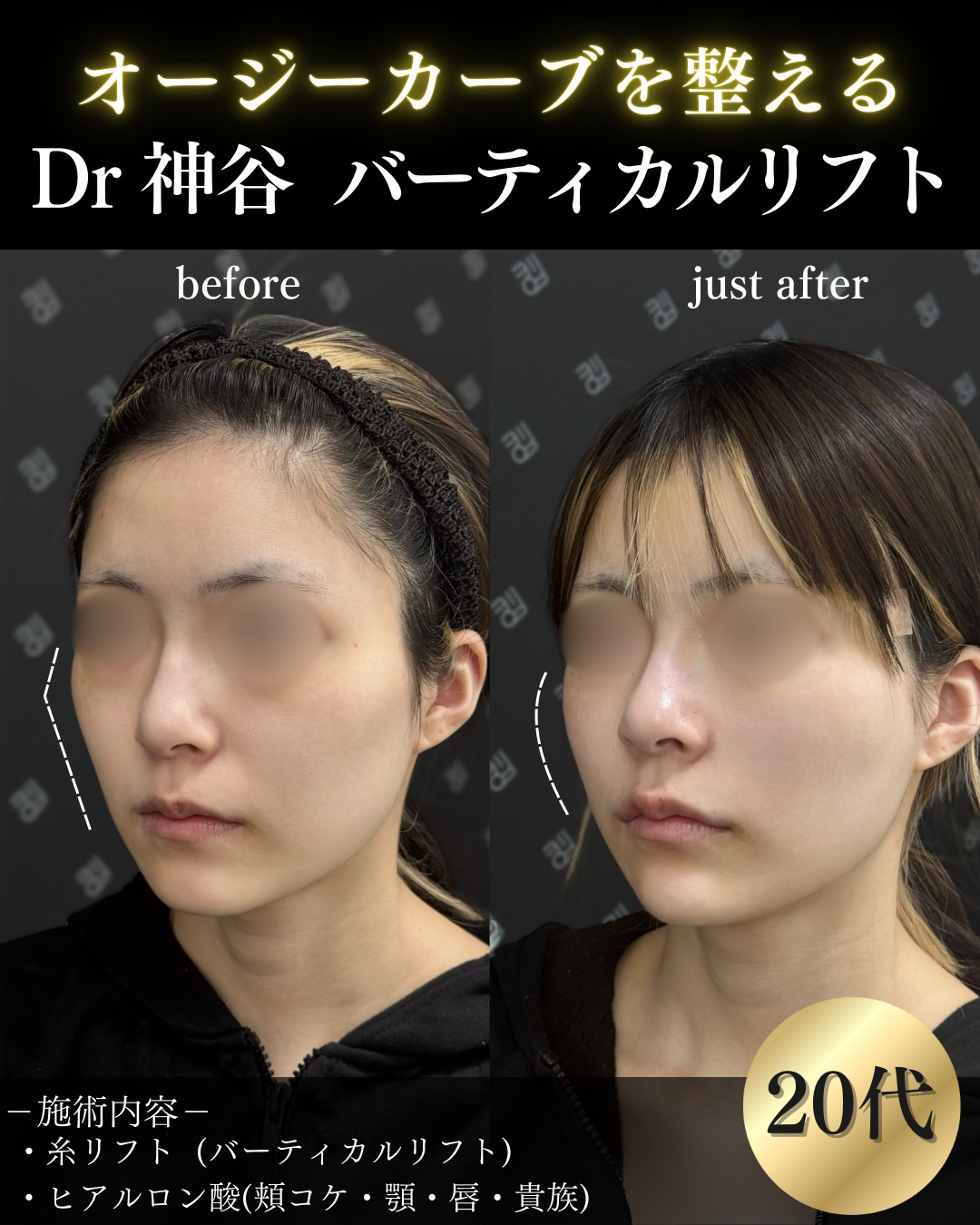 バーティカルリフトー症例写真