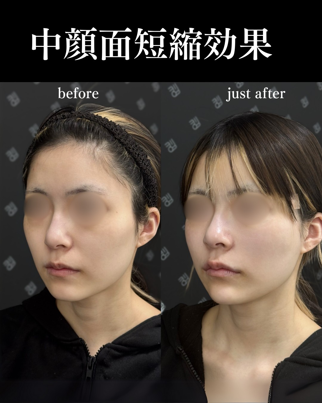 バーティカルリフトー症例写真