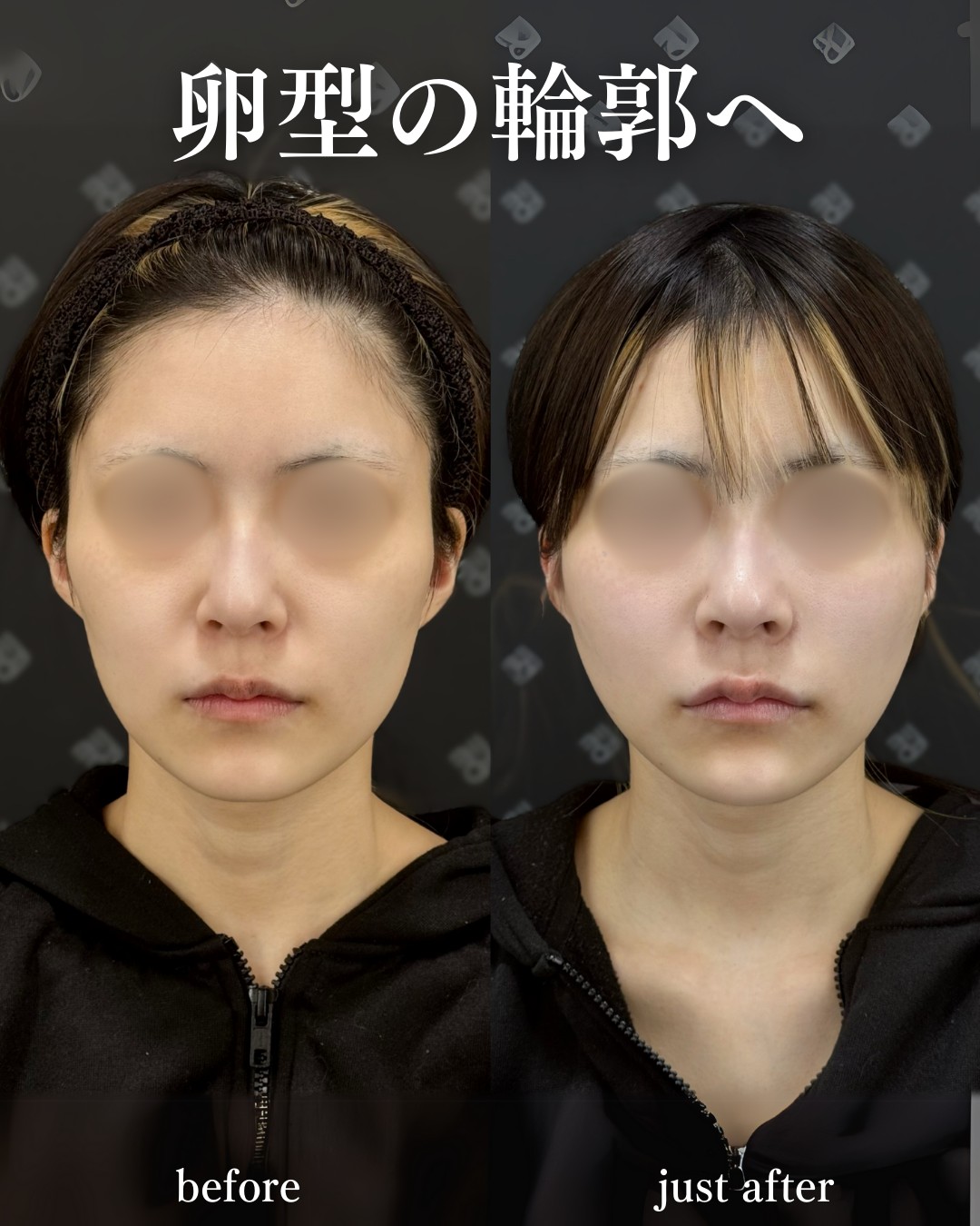 バーティカルリフトー症例写真