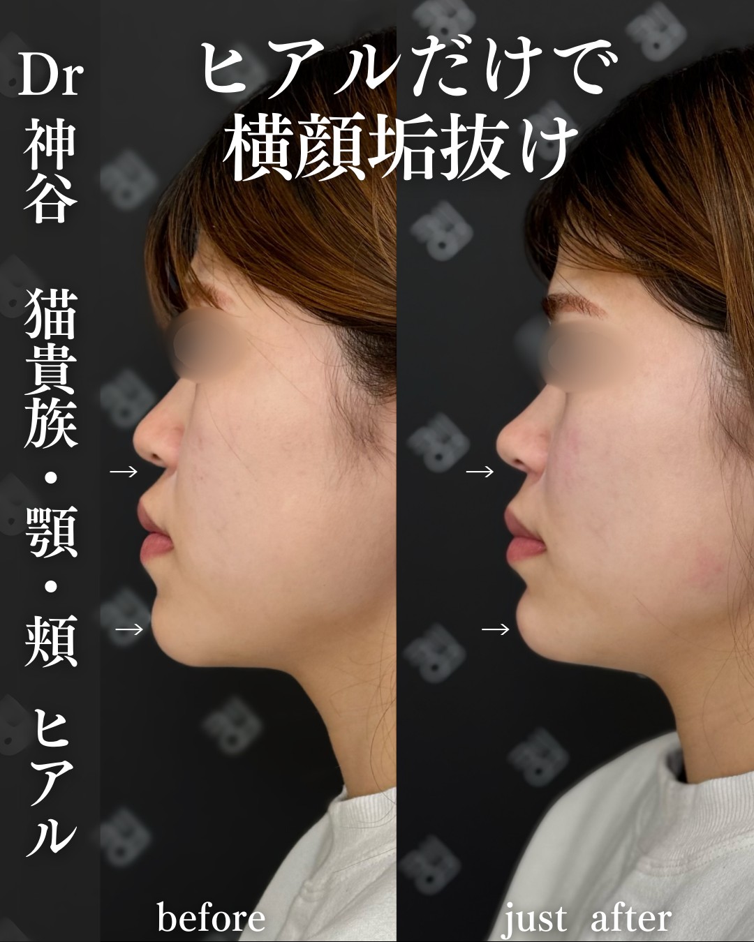 ヒアルロン酸ー症例写真