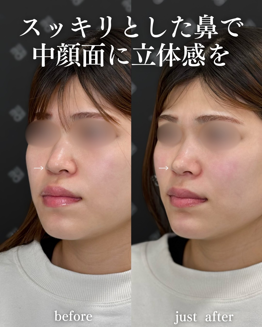 ヒアルロン酸ー症例写真
