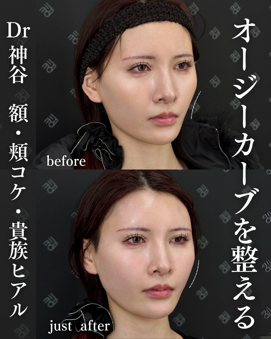 ヒアルロン酸ー症例写真
