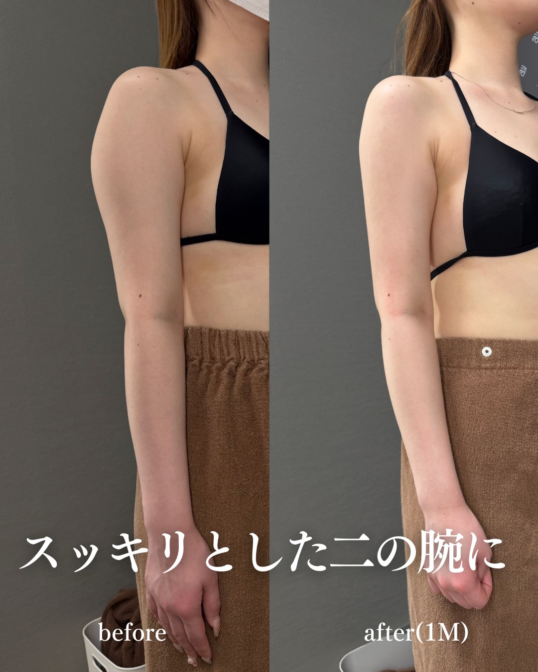 二の腕脂肪吸引ー症例写真