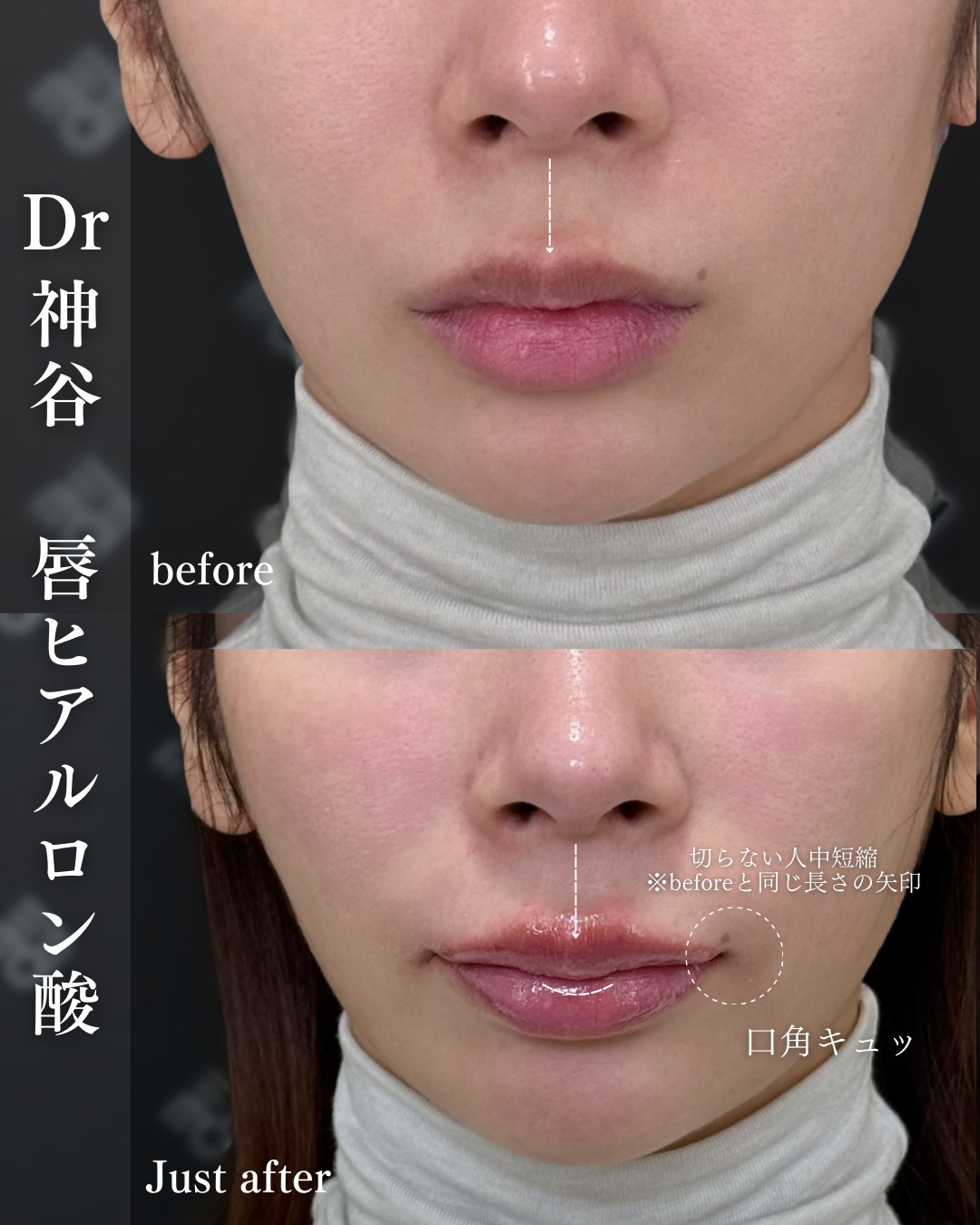 唇ヒアルロン酸ー症例写真