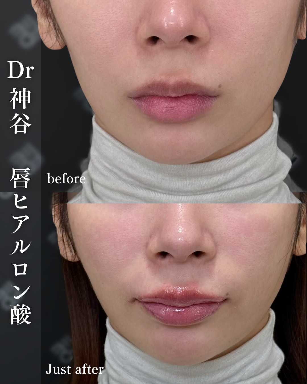 唇ヒアルロン酸ー症例写真