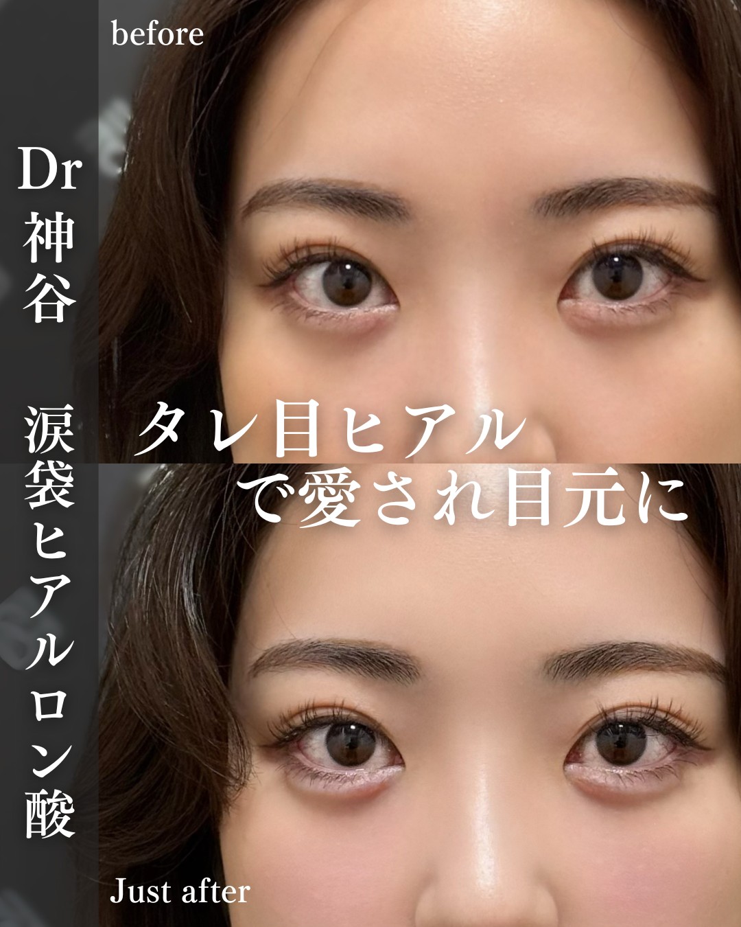 涙袋ヒアルロン酸ー症例写真