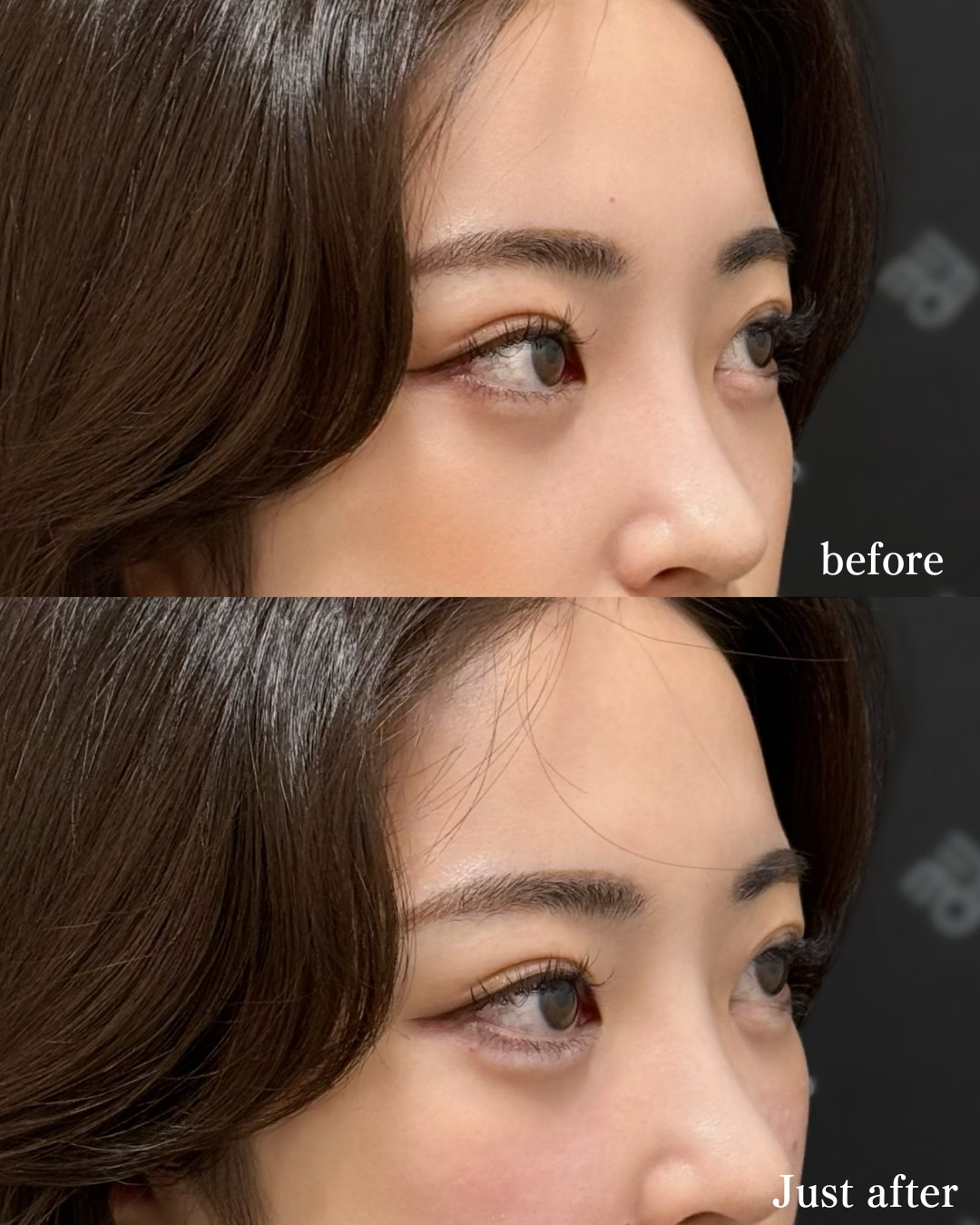 涙袋ヒアルロン酸ー症例写真