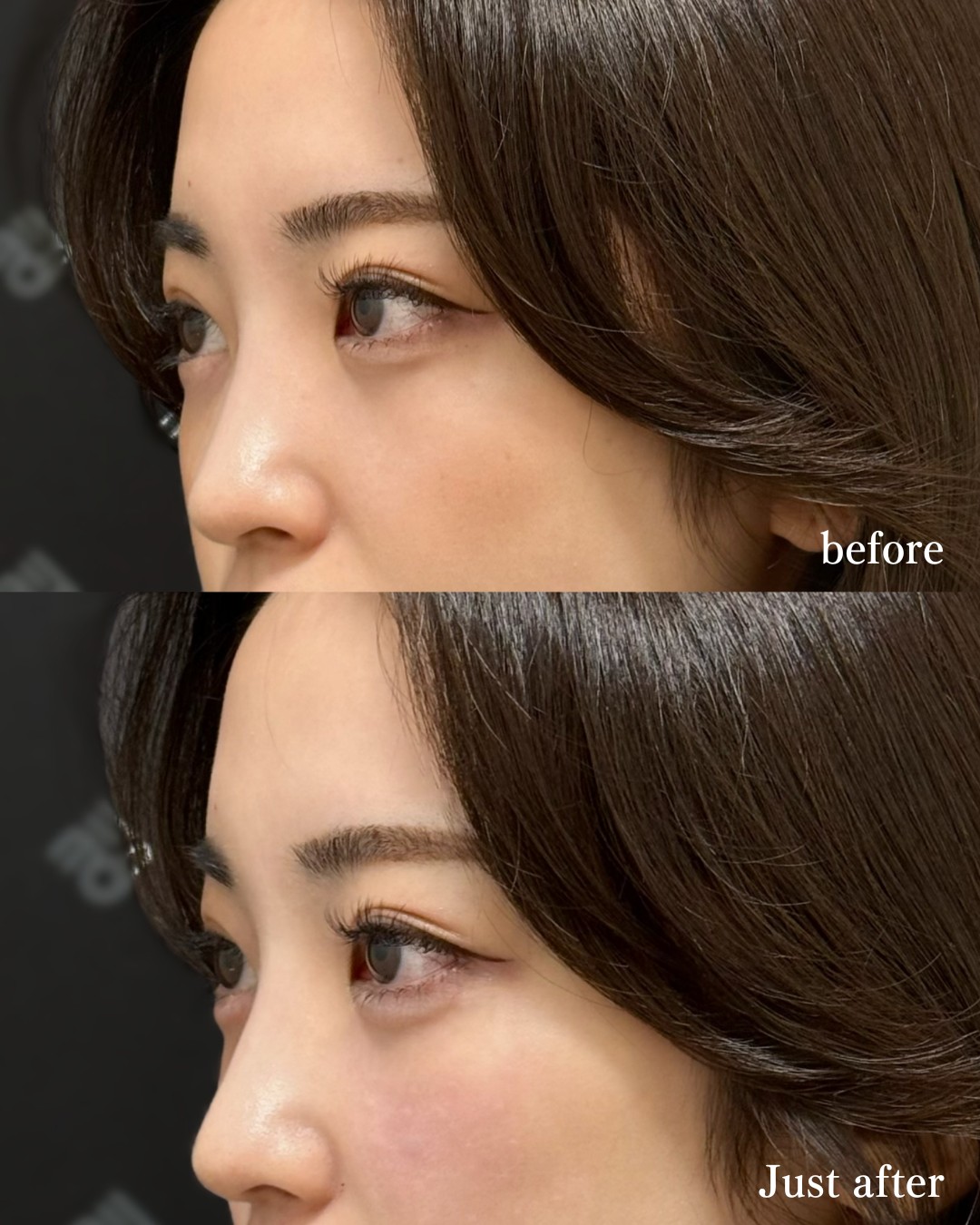 涙袋ヒアルロン酸ー症例写真