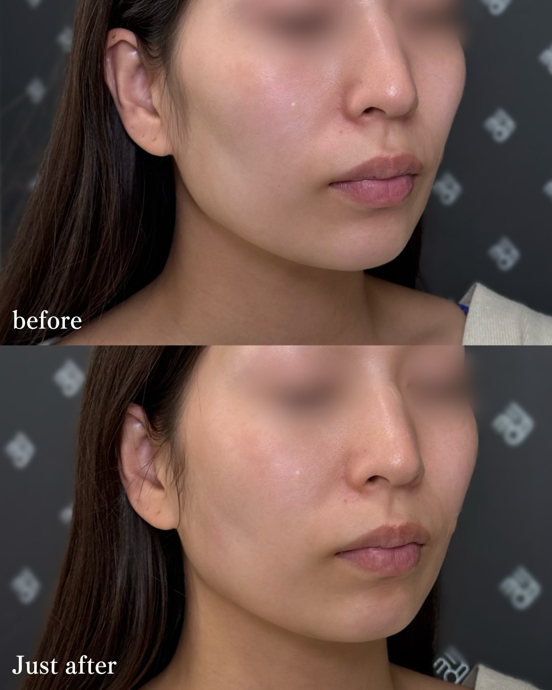 ヒアルロン酸ー症例写真