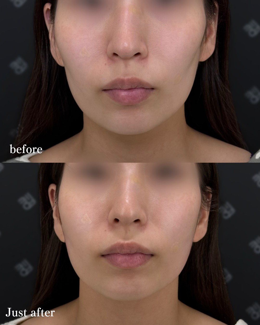 ヒアルロン酸ー症例写真