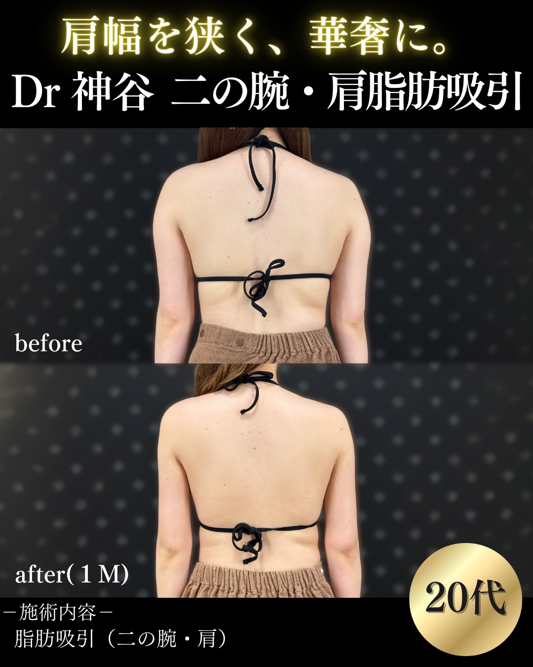 二の腕脂肪吸引ー症例写真