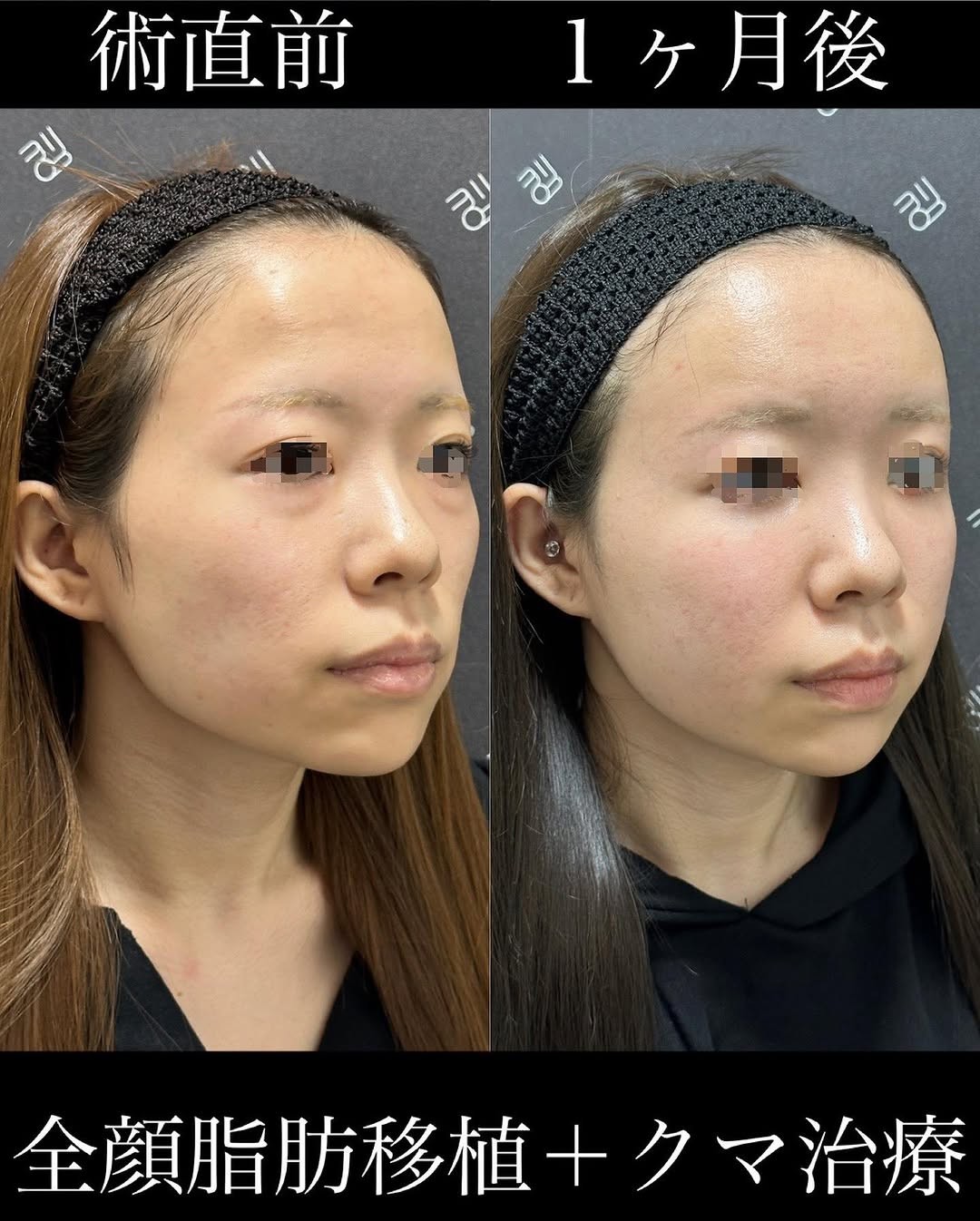 目の下のたるみがある人とない人の違い！たるみの原因やおすすめの美容施術とは | EMMO FACE CLINIC｜大宮 東京三田 大阪梅田 の ...