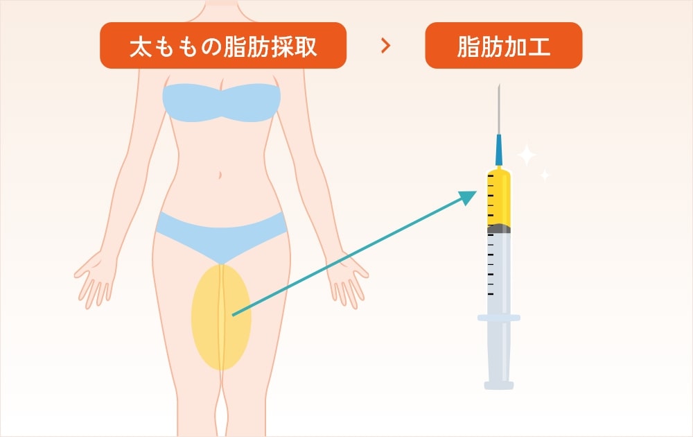 目の下の脂肪注入の施術手順