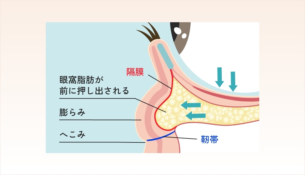 眼窩脂肪のふくらみ