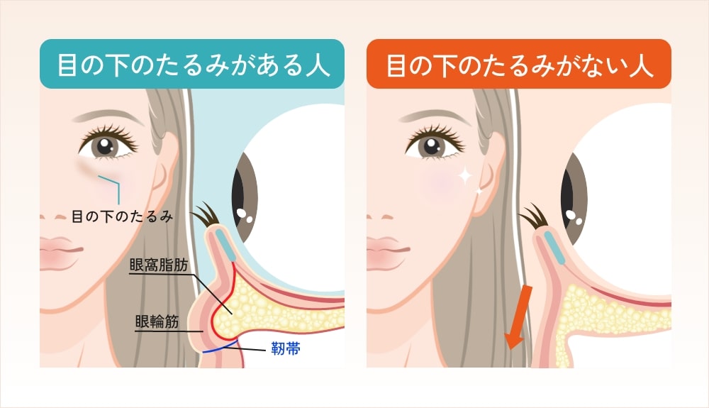 目の下のたるみがある人とない人の違い