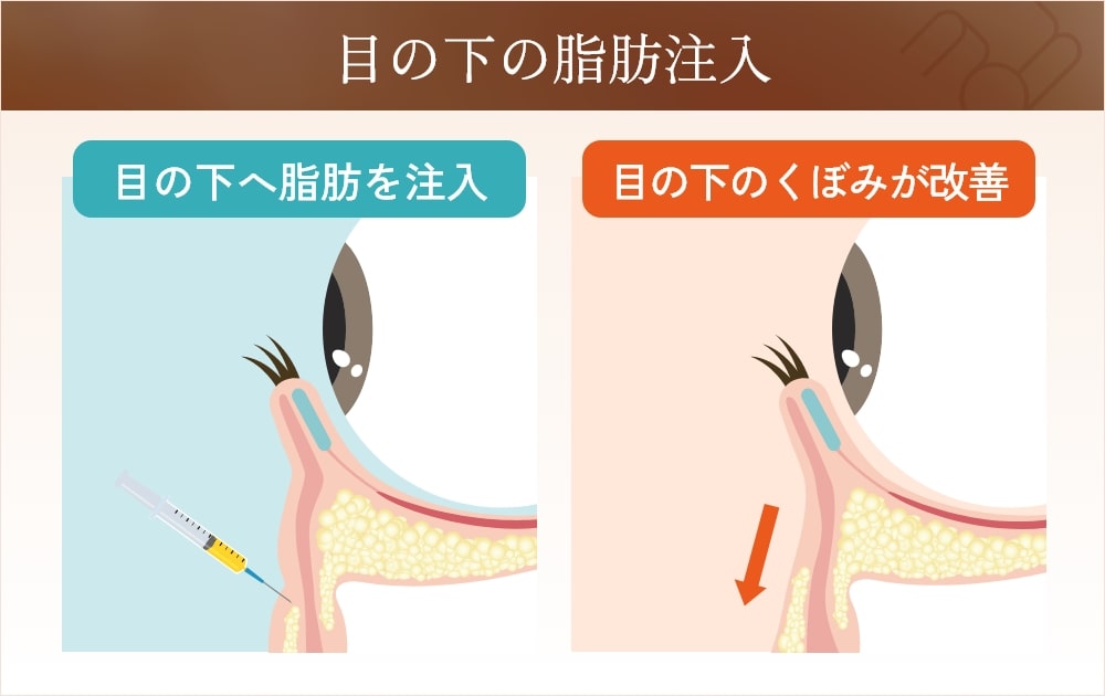 目の下の脂肪注入
