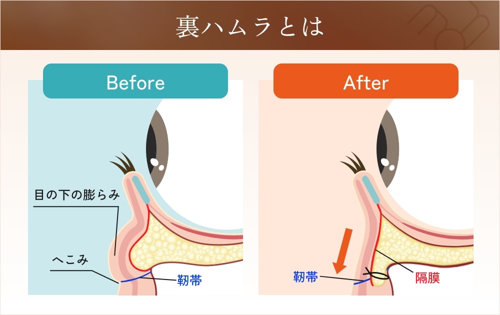 裏ハムラ法