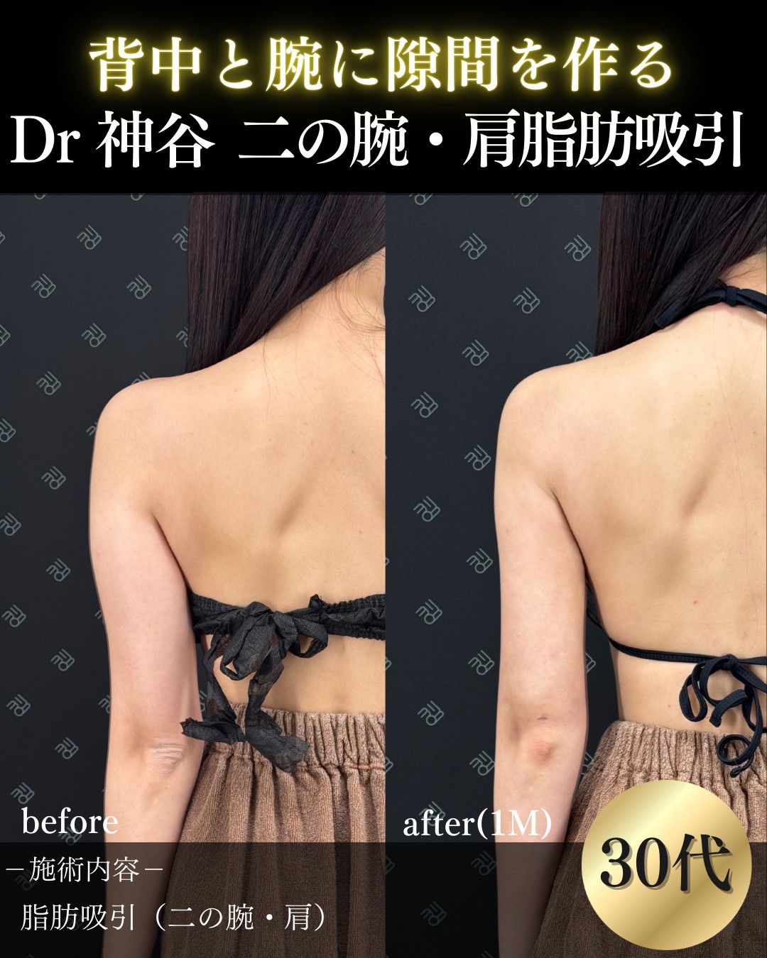 脂肪吸引ー症例写真