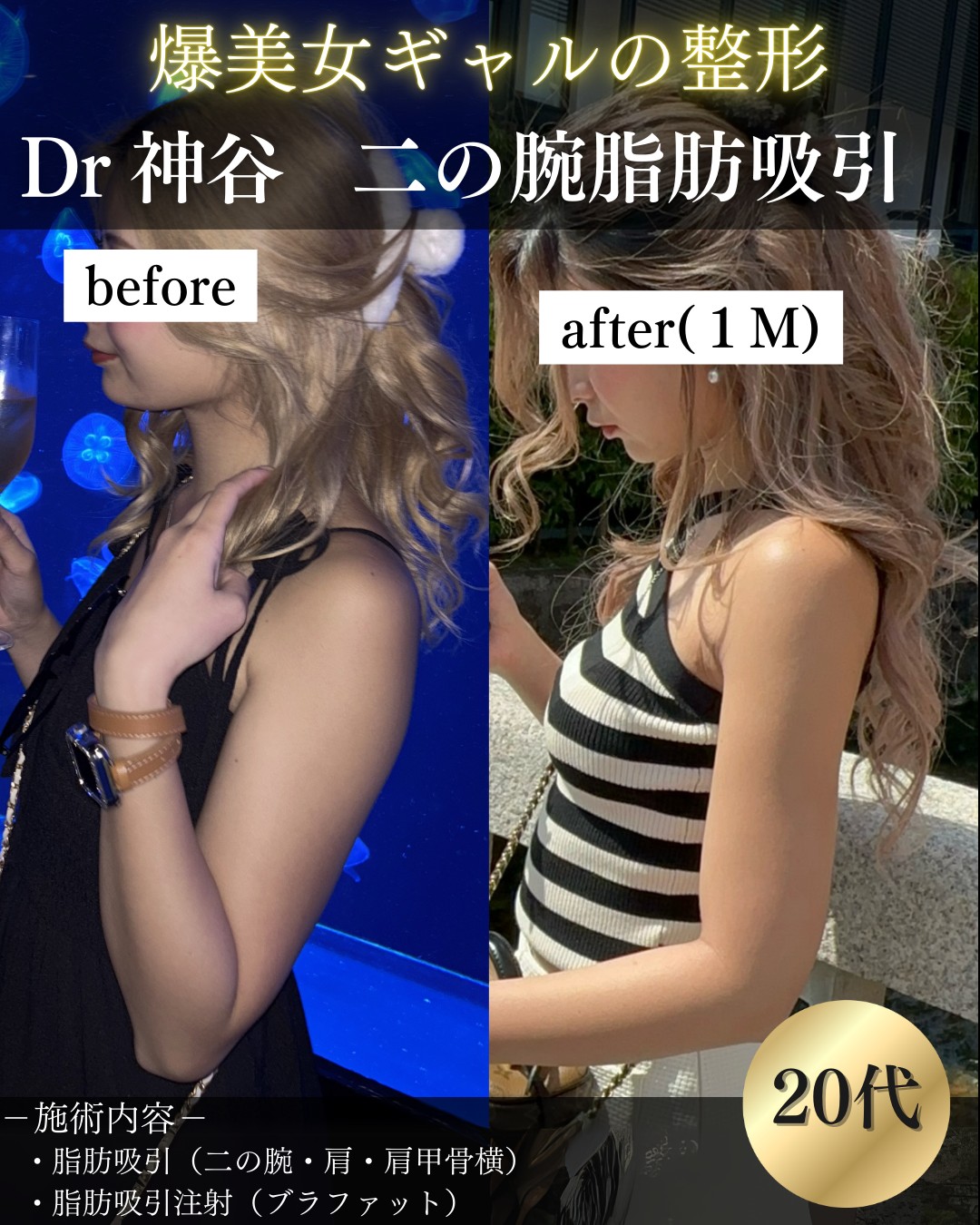脂肪吸引ー施術の説明