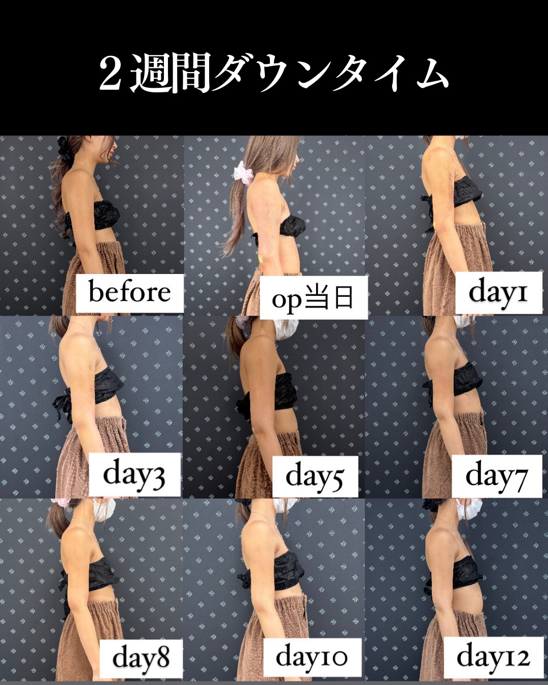 脂肪吸引ー施術の説明