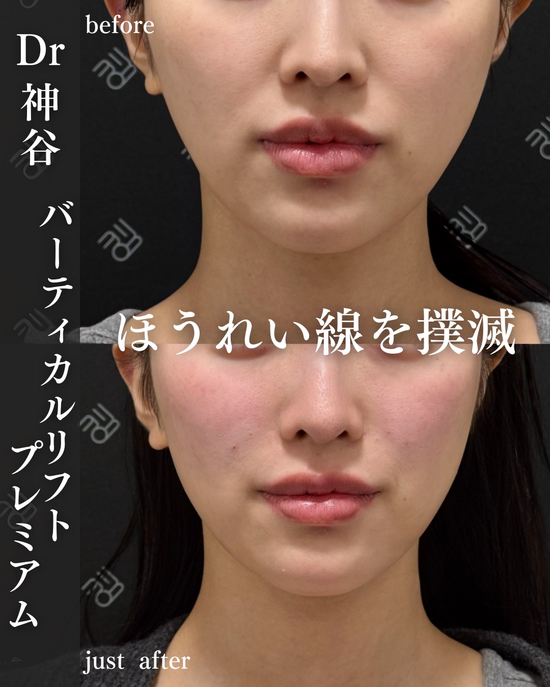 バーティカルリフトー症例写真
