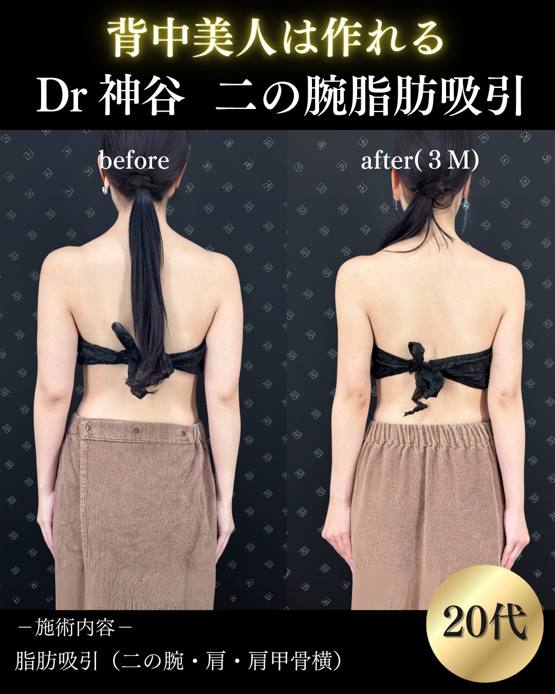 脂肪吸引ー症例写真