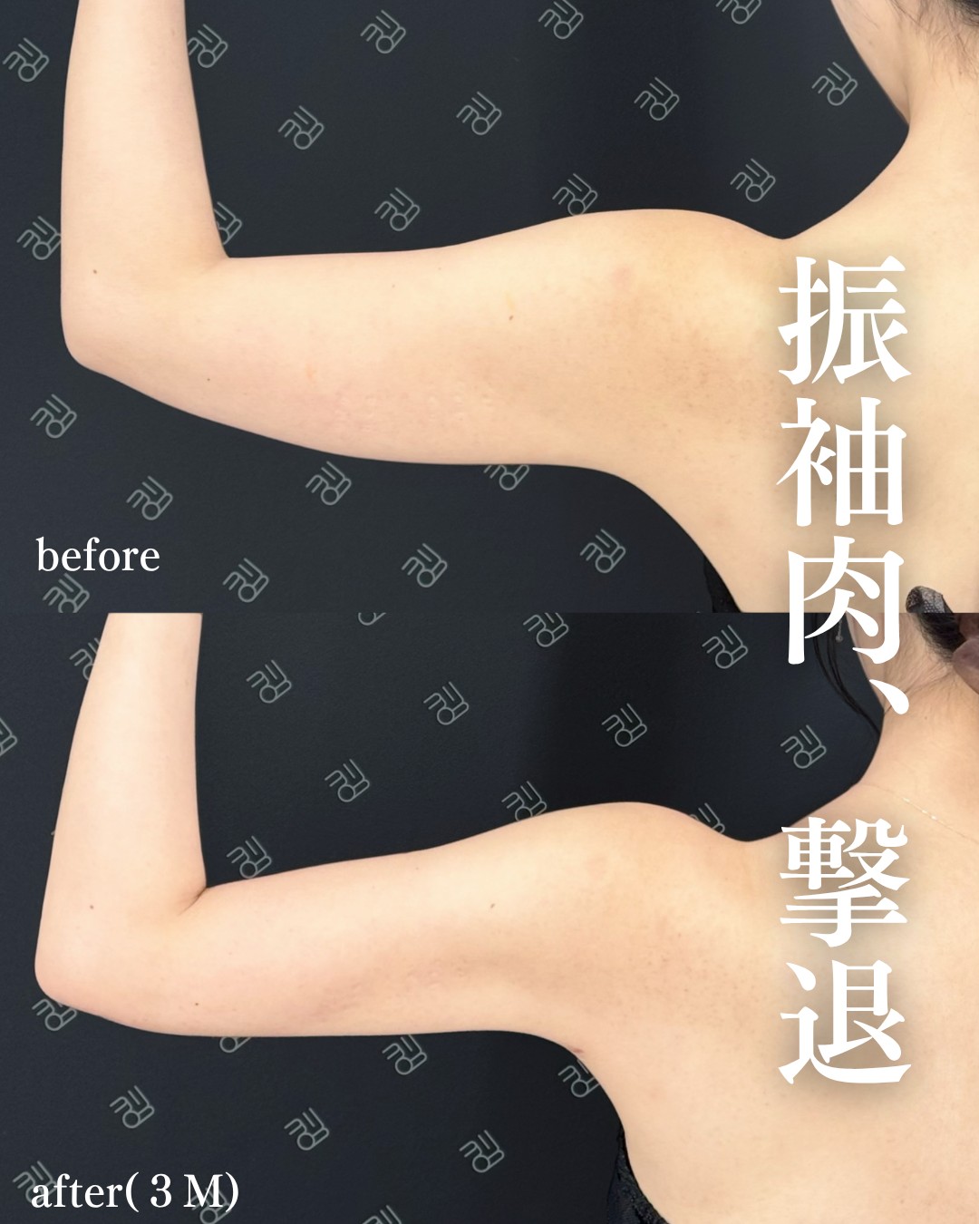 脂肪吸引ー症例写真