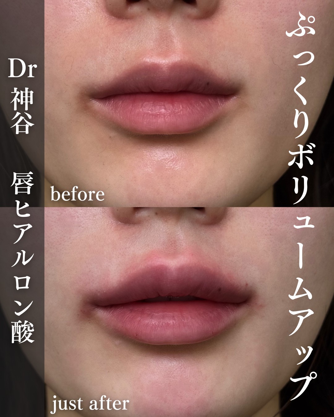 唇ヒアルロン酸ー症例写真