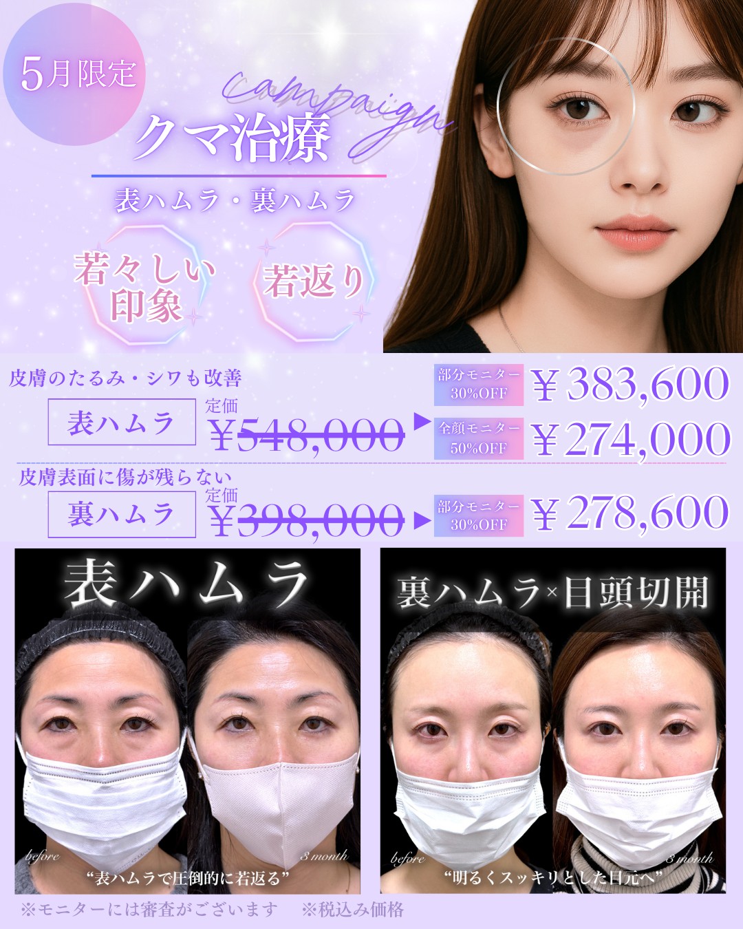 百瀬Drーキャンペーン