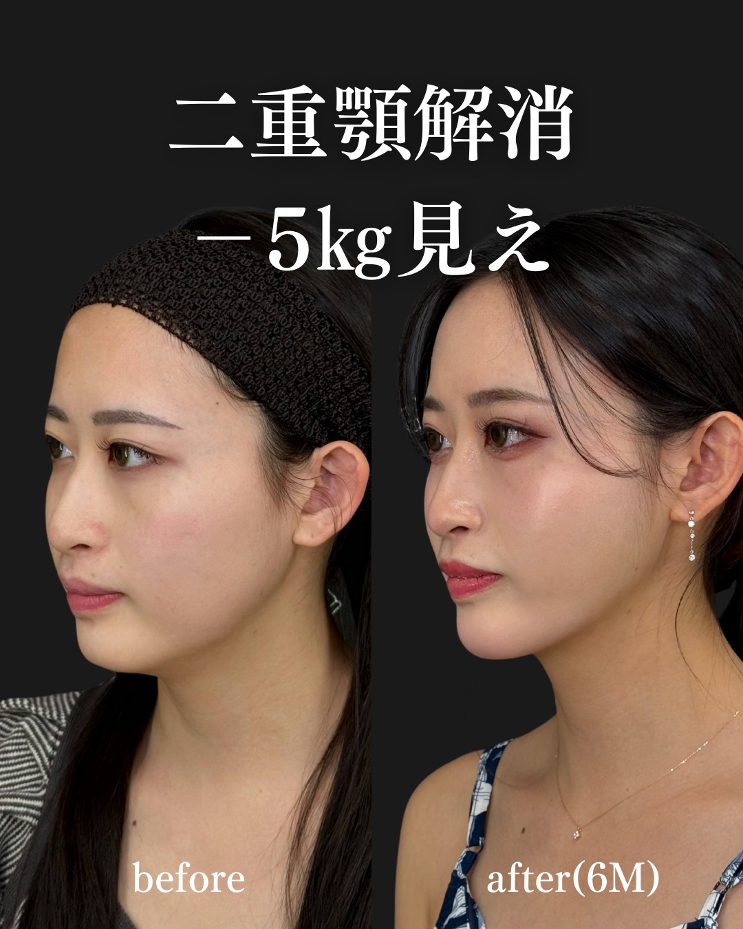 脂肪吸引注射ー症例写真