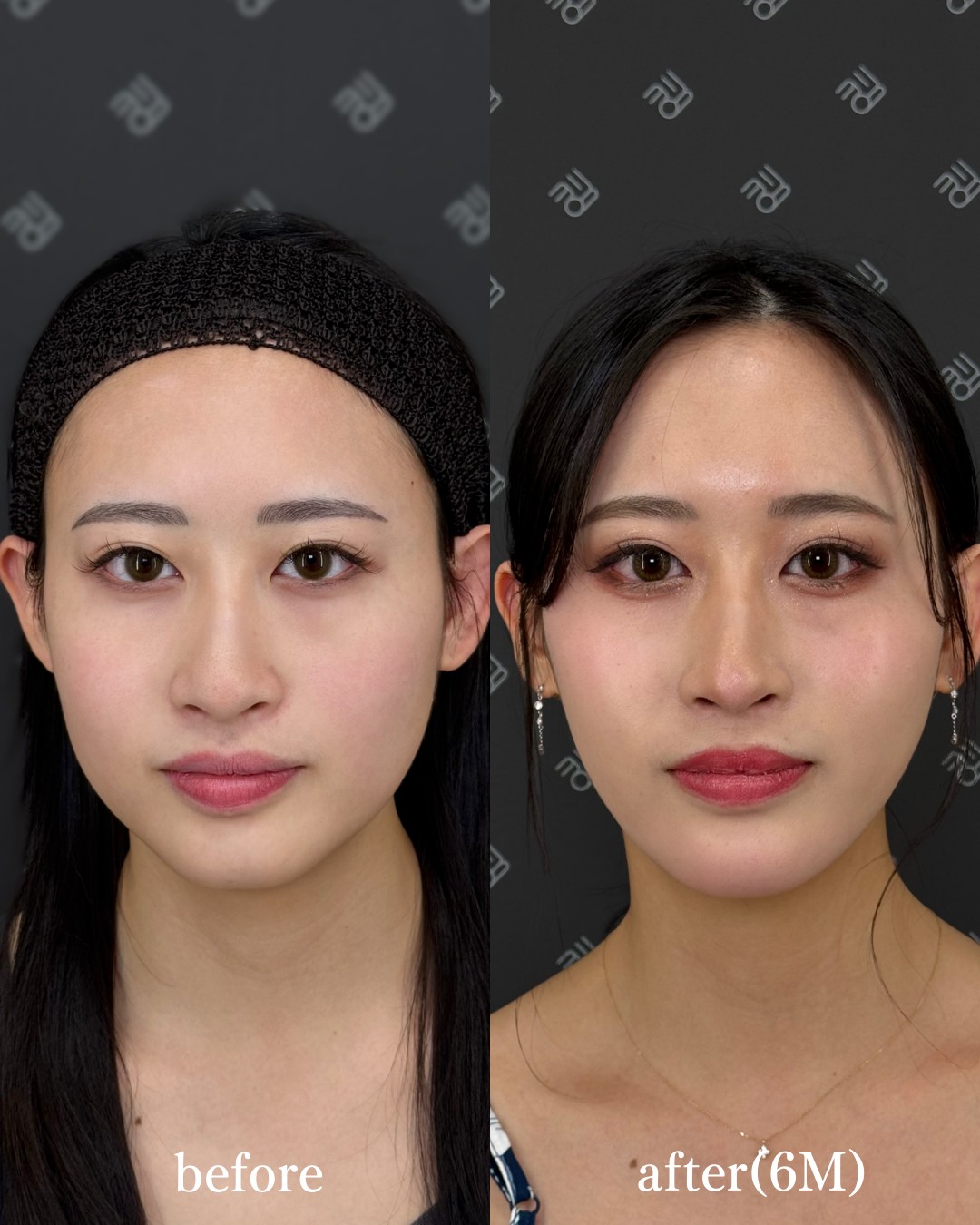 脂肪吸引注射ー症例写真