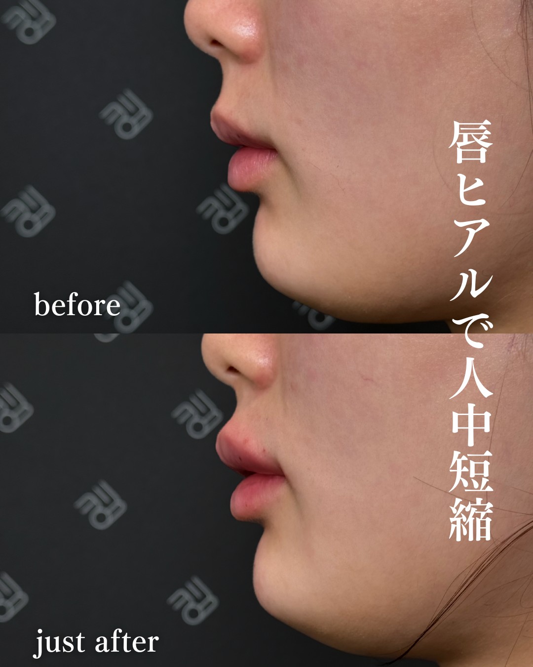 唇ヒアルロン酸ー症例写真