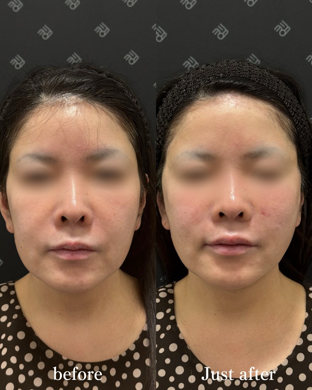 バーティカルリフトー症例写真
