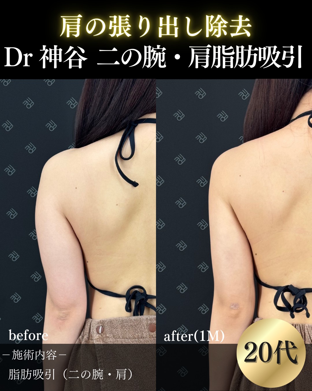 脂肪吸引ー症例写真