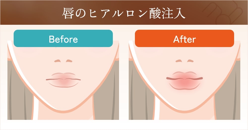 唇のヒアルロン酸注入