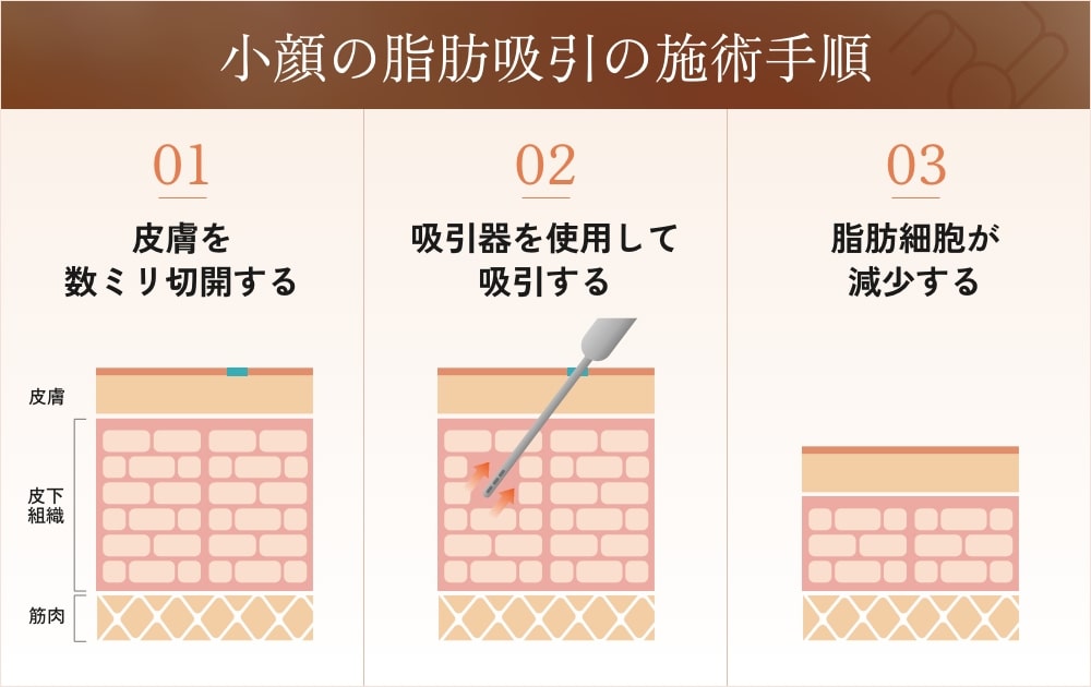 小顔の脂肪吸引