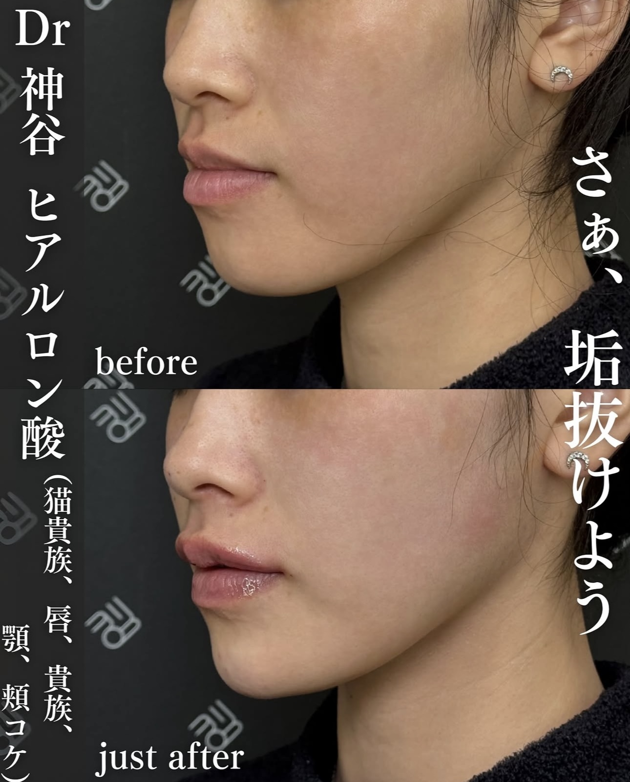 ヒアルロン酸ー症例写真