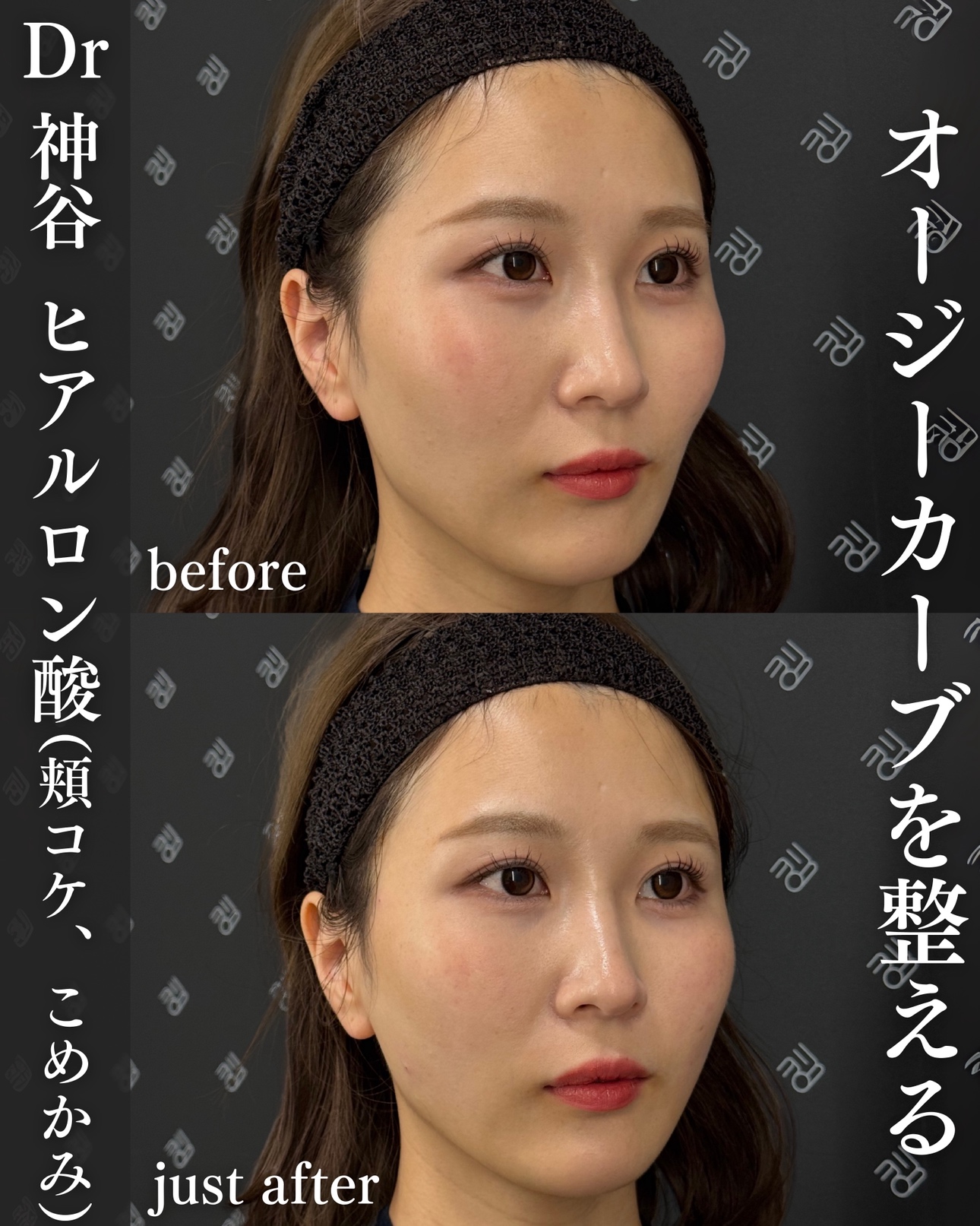 ヒアルロン酸ー症例写真