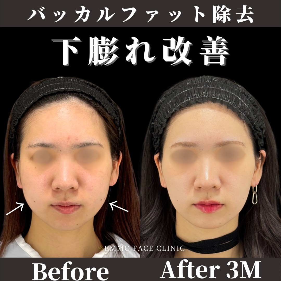 バッカルファット除去