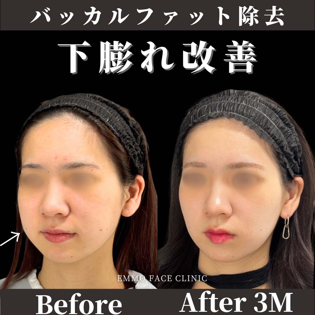 バッカルファット除去