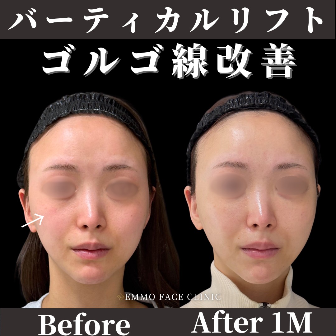 バーティカルリフト