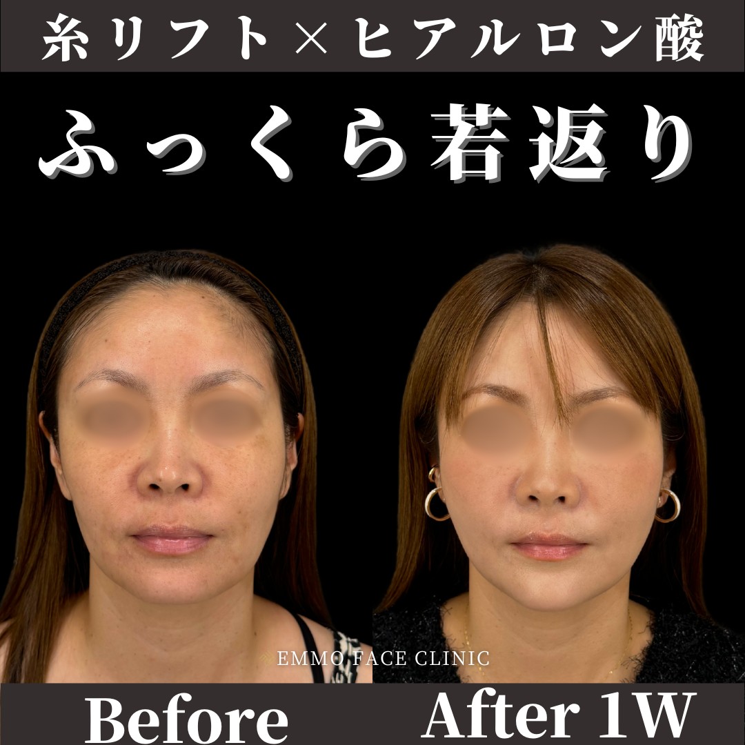 糸リフト×ヒアルロン酸